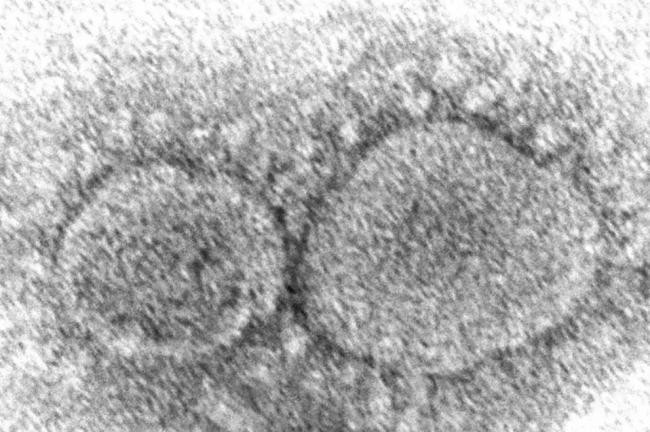 电子显微镜下的新冠肺炎病毒
